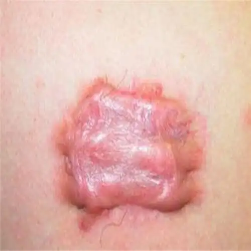 性病软下疳女性局部图片