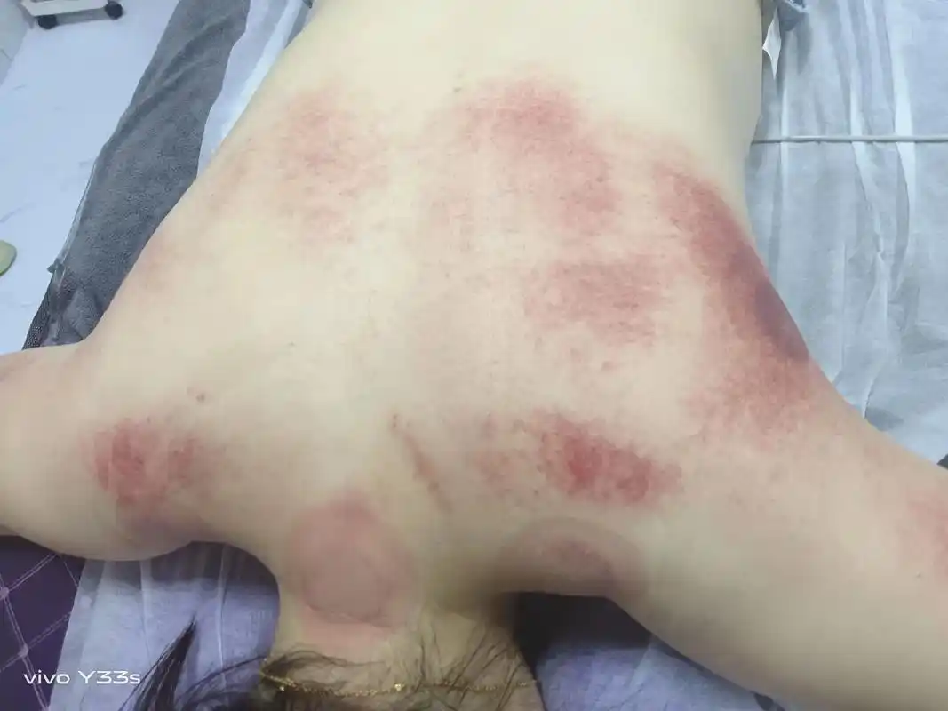 (肩颈保养)肩颈堵了——头疼