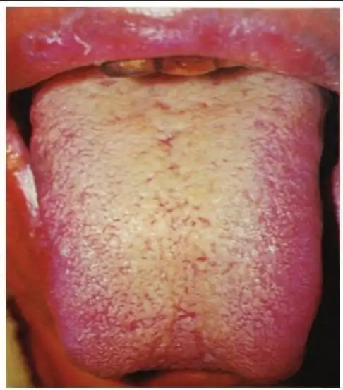 【主病】脾胃虚弱,湿热停聚.