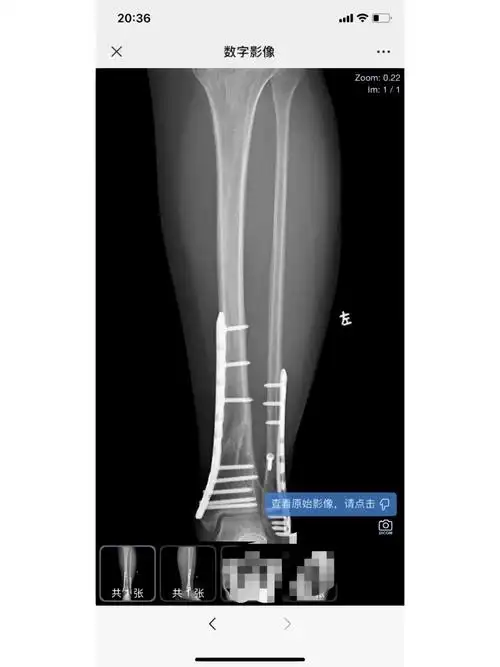 胫腓骨骨折拆钢板