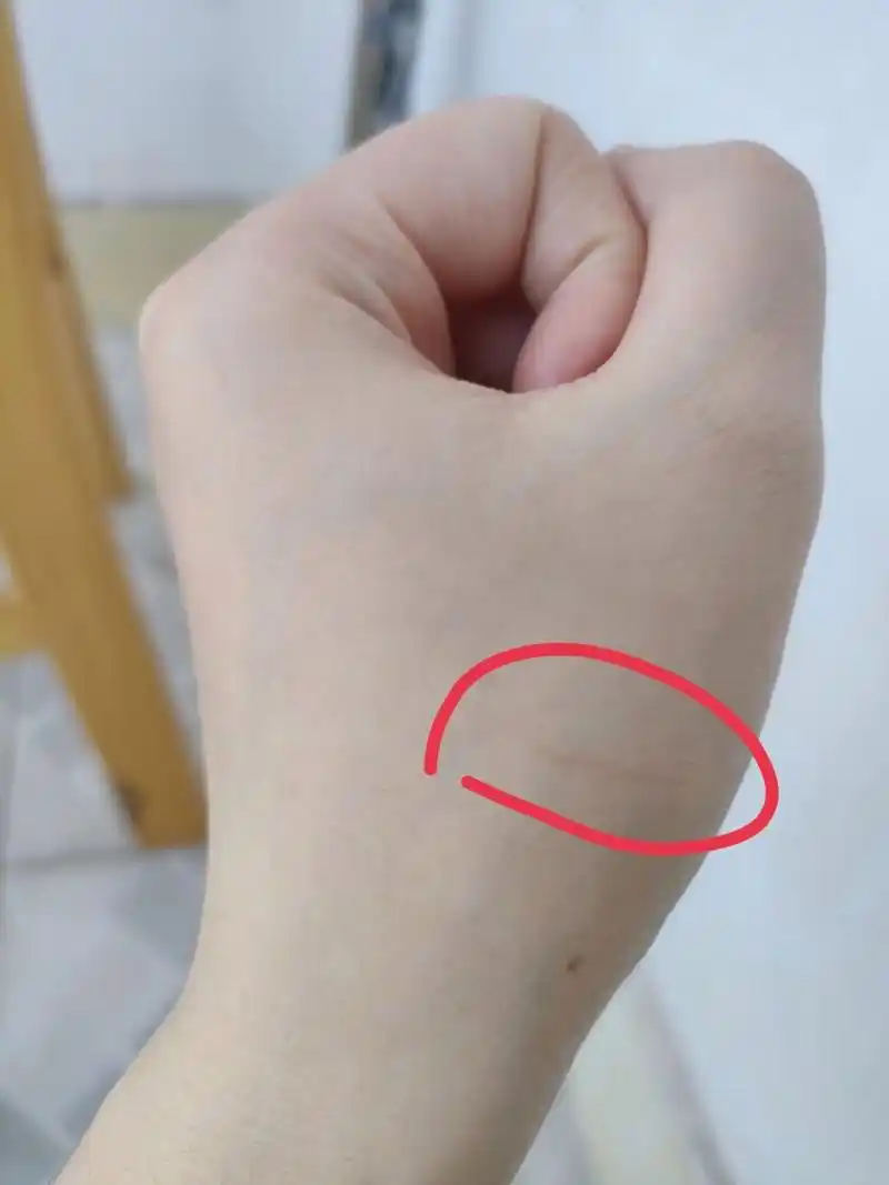 玩猫被咬到看起来没破皮要去打针吗 上午去玩猫了,不小心被咬到刚咬到