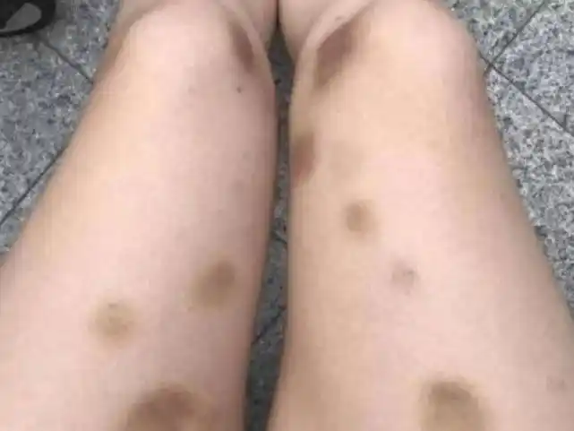 莫名其妙出现青紫色的瘀斑,而且也没收到什么撞击,同时自己患有肝病