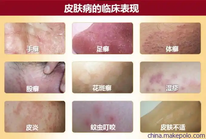 供应皮管家ve皮肤抑菌膏纯正配方专业生产