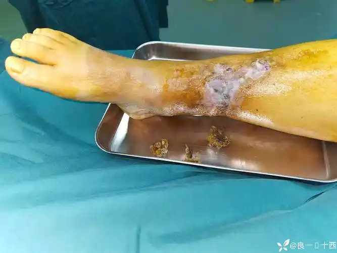 小武日记之心诚则灵(骨髓炎结局) - 丁香园论坛