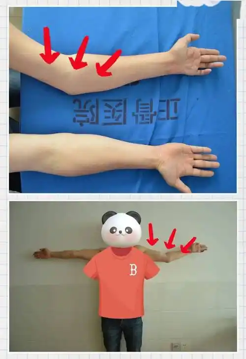 【正骨科普】胳膊肘往外拐是病,能治!_畸形_治疗_肘关节