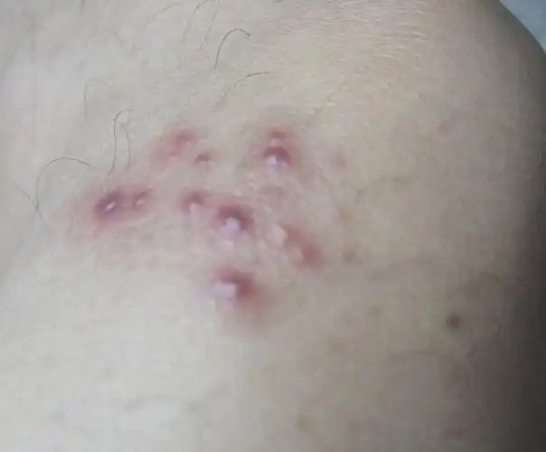 女性梅毒初期症状