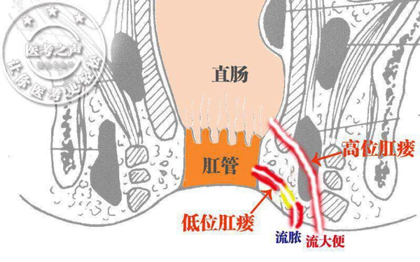 肛瘘是怎么形成的?医生:一般是这些因素