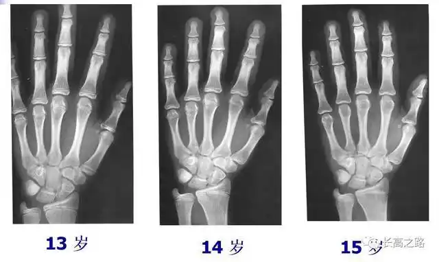 教你简单识别孩子的骨龄片