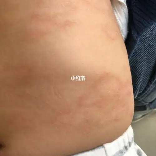 我家宝宝的干性湿疹真的蛮严重的,现在6个月已经有了3个月了.