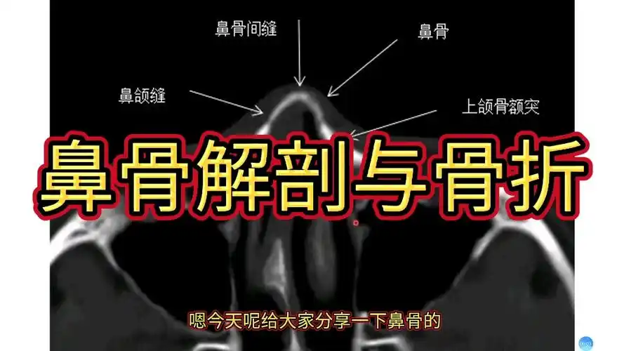 影像基础:鼻骨解剖及鼻骨骨折ct表现讲解!