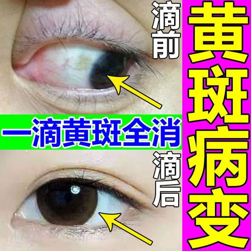 去除眼底黄斑病变眼药水眼白清澈去丨黄眼睛混浊干涩发痒模糊滴眼液 1