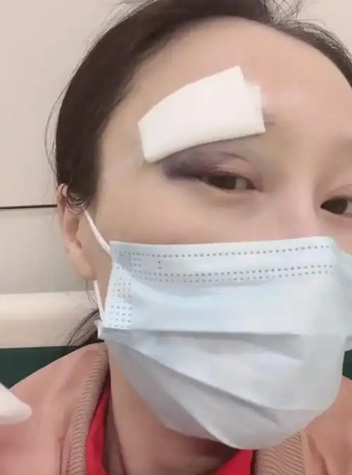 她的眉毛那一块被纱布包扎起来了,伤势颇为严峻.曝光的画面中魏晨肖