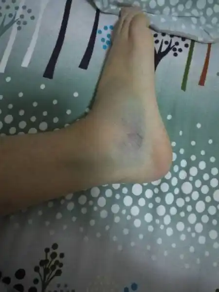 前天脚崴了,摔跤了,图片是昨天拍的脚受伤的程度,请了两天假期,明