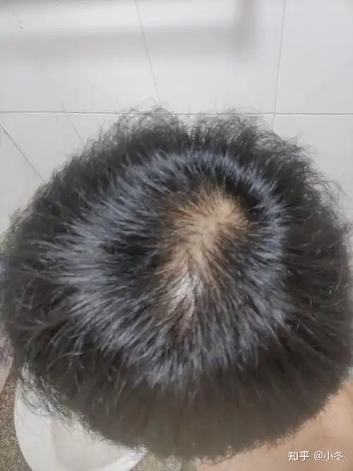 刚20头顶发旋处稀疏现在这样 ,是要地中海了吗?