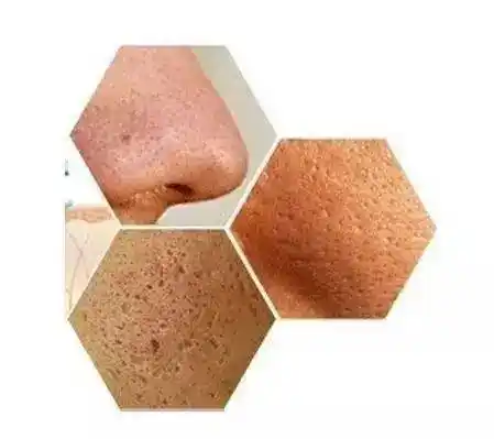 毛孔粗大镶芝麻别孔慌4招解决毛孔粗大适用于各种肤质