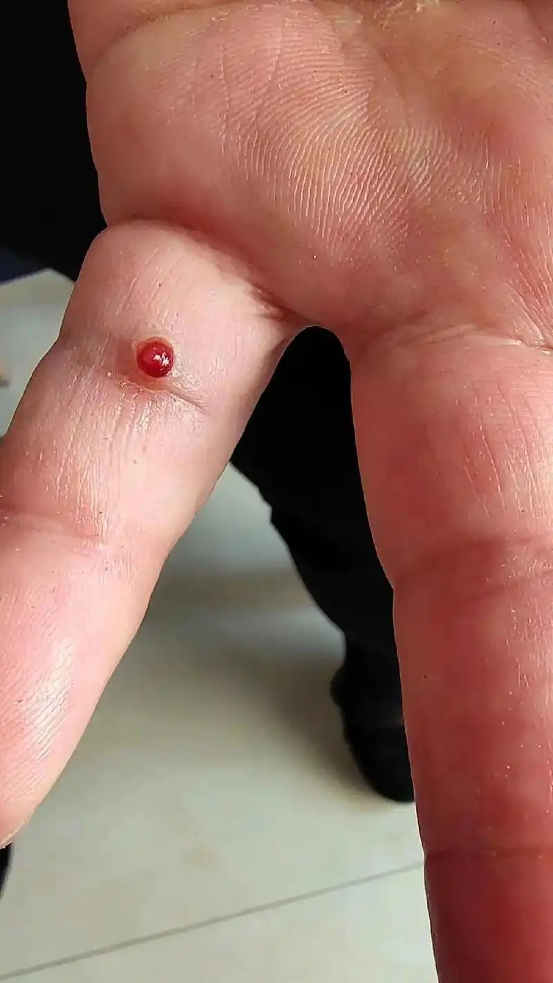 皮肤肉芽肿 #皮肤科医生 #重庆老卫协十一诊所  - 抖音