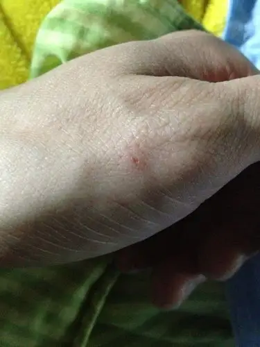 被狗咬了,如图.请问需要打疫苗吗?狗没打过疫苗的.