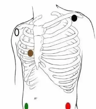 心电监护仪:三导联与五导联有何区别及意义?_电极