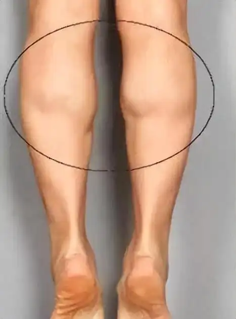 女生小腿肌肉特别结实,怎样才能瘦小腿?