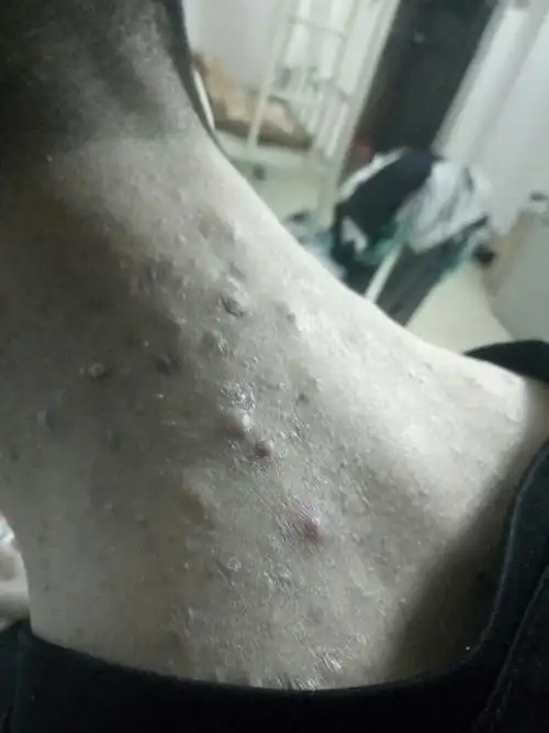 本人后背可能长了毛囊炎,有5年时间了,不知你们有什么方法去掉,快被