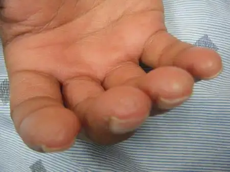 系统性硬化症(硬皮病)