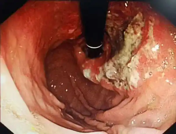 我今年71岁被查出了胃印戒细胞癌