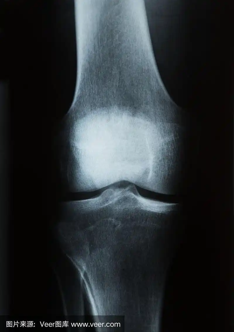 人类膝盖的x光照片