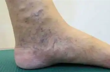 常见静脉曲张离死亡有多近