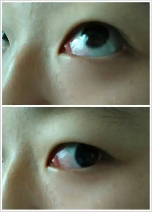 1条回答  那其实不叫做泪腺,而是泪阜,这是局部发生炎性反应的表现.