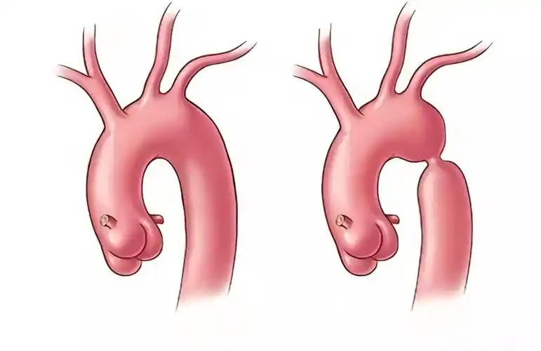 胸段降主动脉重度狭窄,最窄处仅3mm,压差达74mmhg.