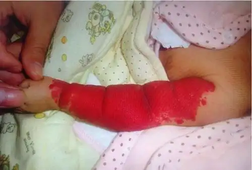 刚出生10天的宝宝手臂变鲜红色,原来是血管瘤所致