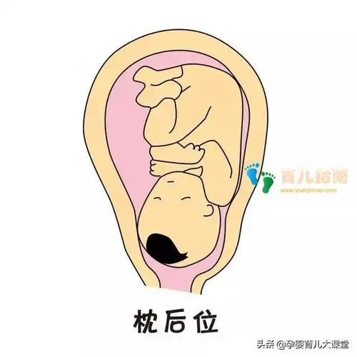 枕后位:在分娩过程中,胎头以枕后位或枕横位衔接.