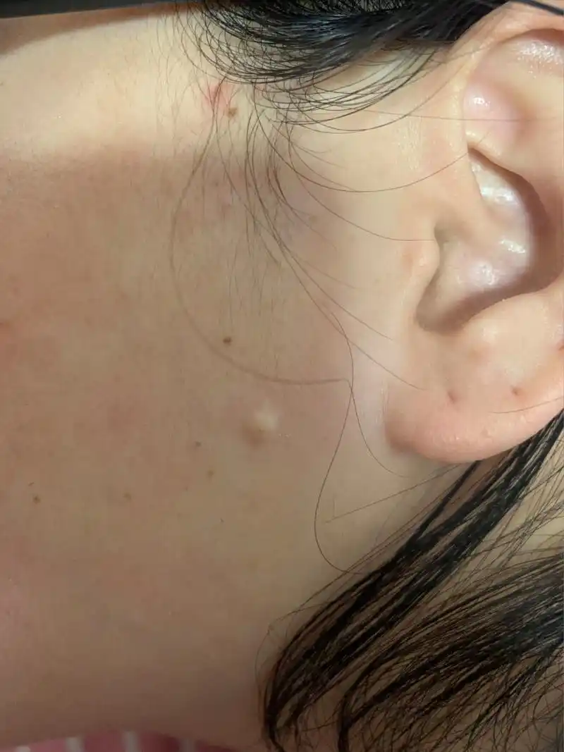 皮脂腺囊肿 粉瘤 新鲜出炉的报告96 左侧脸部靠近耳朵的位置,长了一