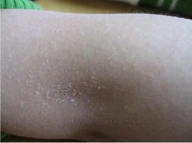 男性成人背部痱子图片