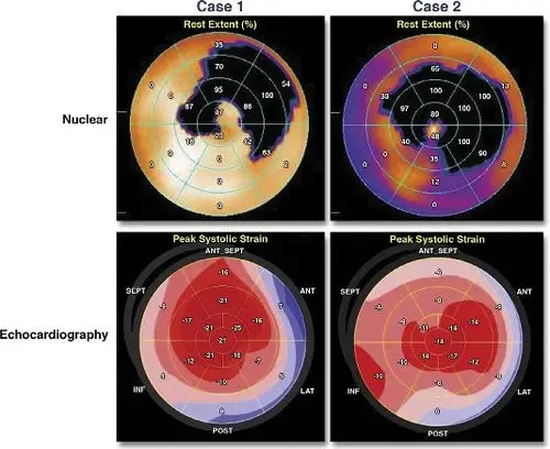 病例1和299mtc-pyp显像牛眼图提示淀粉样变性,超声心动纵向应变峰值极