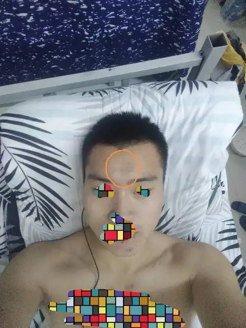 暂未定制 向ta提问私信ta  展开全部 额头中间的位置出现了一个坑,有