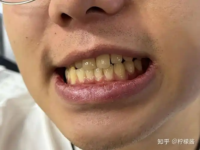 长期抽烟牙齿很黄,怎么才能变白? - 知乎