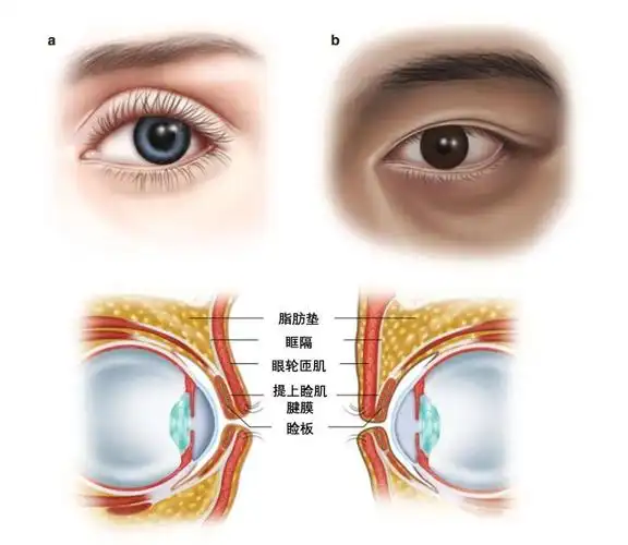"和我们不太一样,他们的这道沟在更高的位置,给人一种眼窝深的感觉