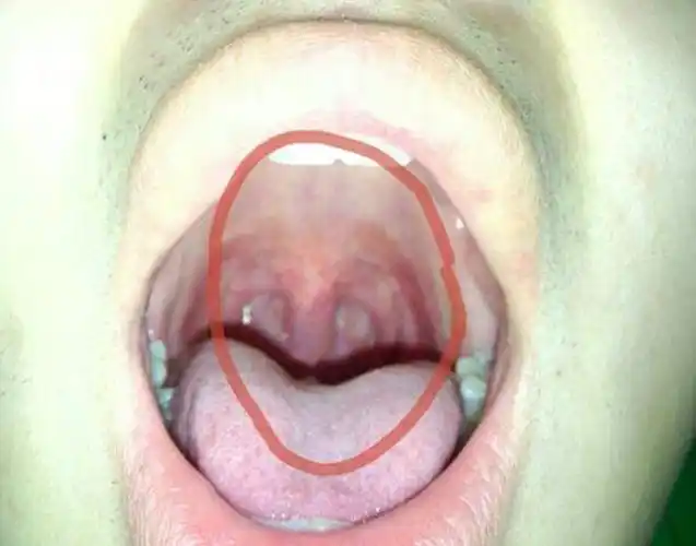 扁桃发炎图-图片大观-奇异网