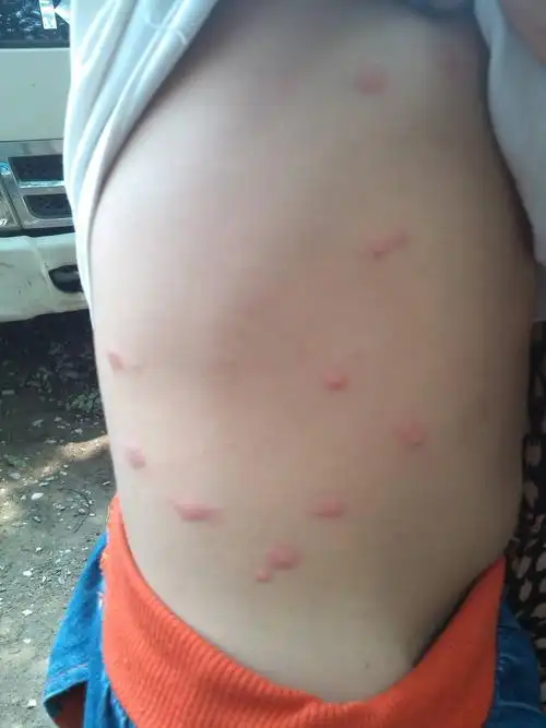 问:孩子身上昨天起了些红疙瘩.请大家看看是怎么了?有知道的吗?