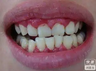 牙龈炎的早期症状图片是什么样的