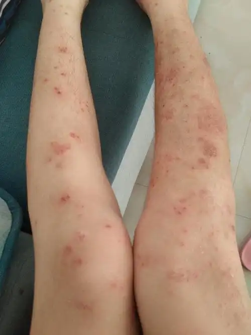 湿疹太痒了怎么办 湿疹晚上特别痒怎么办