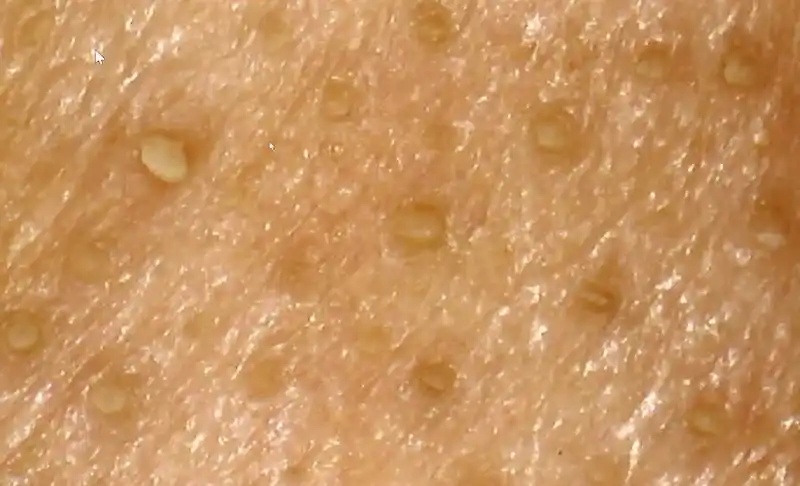 还在用鼻贴撕黑头很抱歉这样并不能把黑头粉刺拔出来