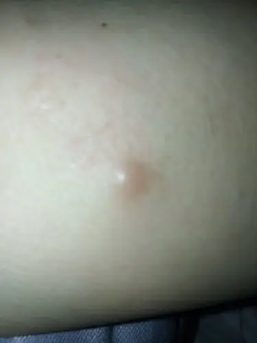 皮肤肿包硬硬的,不痒但按着痛.