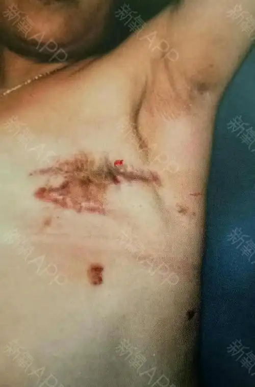 这是我乳腺癌切除后疤痕发生了增生,病痛的折磨让我苦_圈子-新氧美容