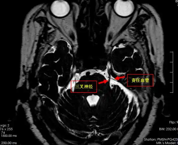 术中,医生发现一根动脉血管正压迫三叉神经,这就是患者疼痛的原因.