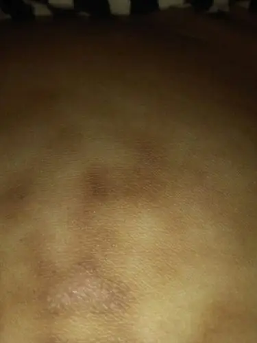 天天做艾灸肚皮一层黑皮就像烫伤的一样时间长了会淡掉吗