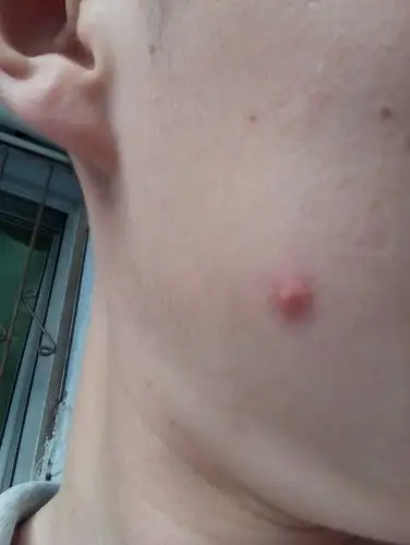 孢子性毛囊炎我觉得医生诊断不对啊大伙帮我看看怎么搞这玩意儿好烦躁