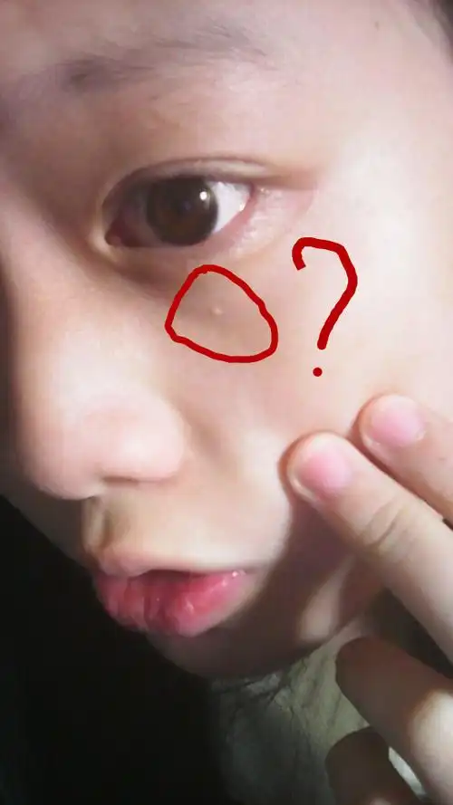 脸上长了一个小白点 粉刺那么大 摸起来比较平滑 tat想知道它会不会不