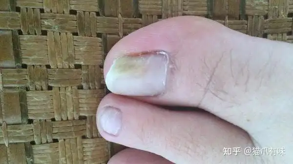 脚上大拇指得了灰指甲,灰指甲原因是什么,大家都说很难治,而且不能